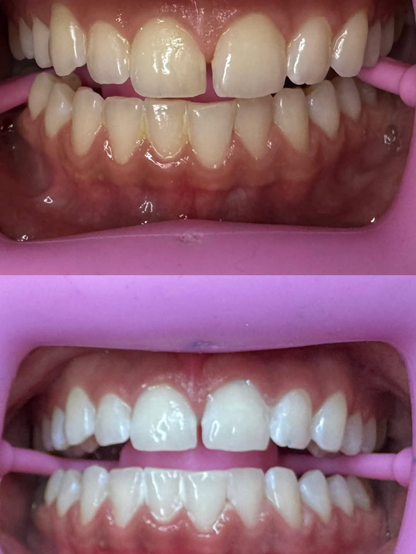 Gels de Blanchiment de Concentration Haute ou Standard (x10 Seringues)