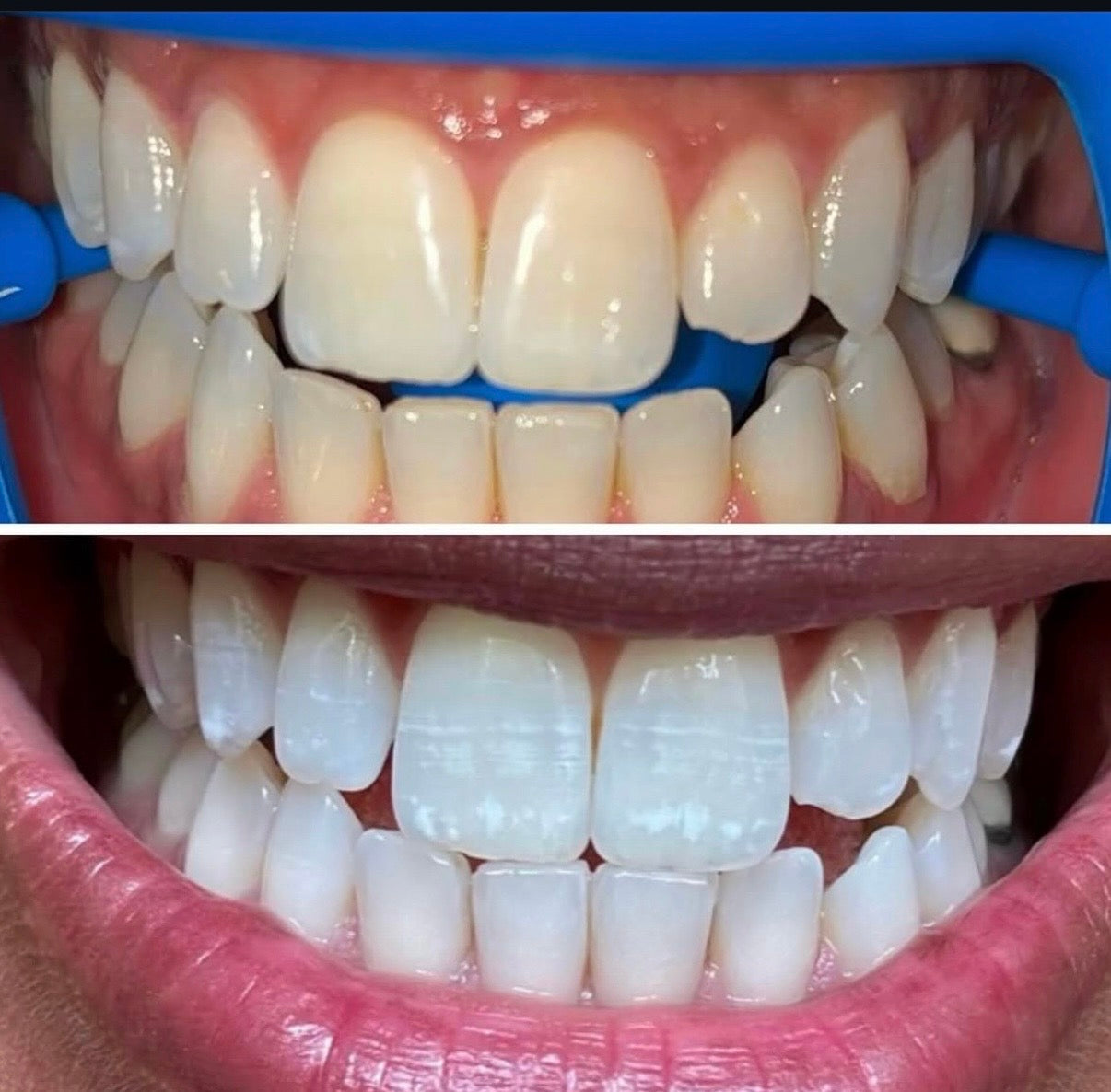 Gels de Blanchiment de Concentration Haute ou Standard (x10 Seringues)