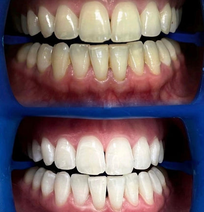 Gels de Blanchiment de Concentration Haute ou Standard (x10 Seringues)